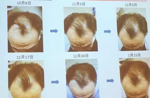 育毛ヘッドスパ