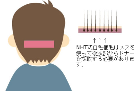 NHT式自毛植毛
