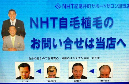 NHT式自毛植毛