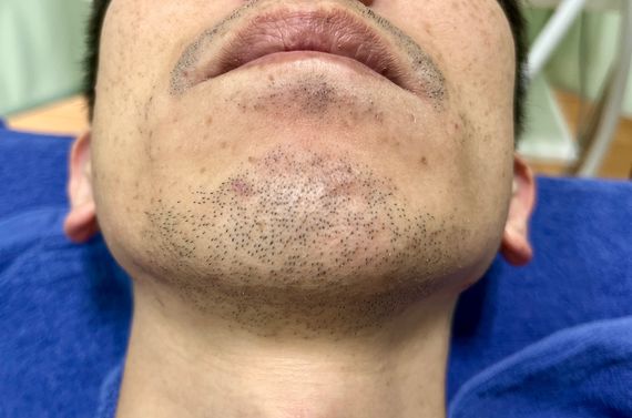 ヒゲ脱毛は君津木更津市のエンゼルヘアサロンが痛くなく効果があると人気です！