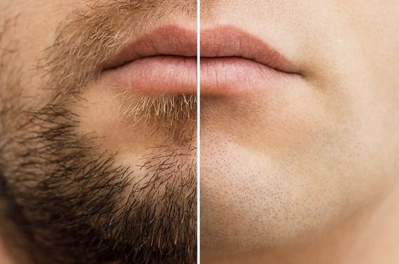 ヒゲ脱毛は君津木更津市で人気の床屋エンゼルが安くて効果があると人気です！